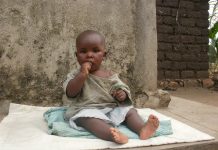 Un enfant victime de malnutrition au Burundi