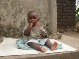 Un enfant victime de malnutrition au Burundi